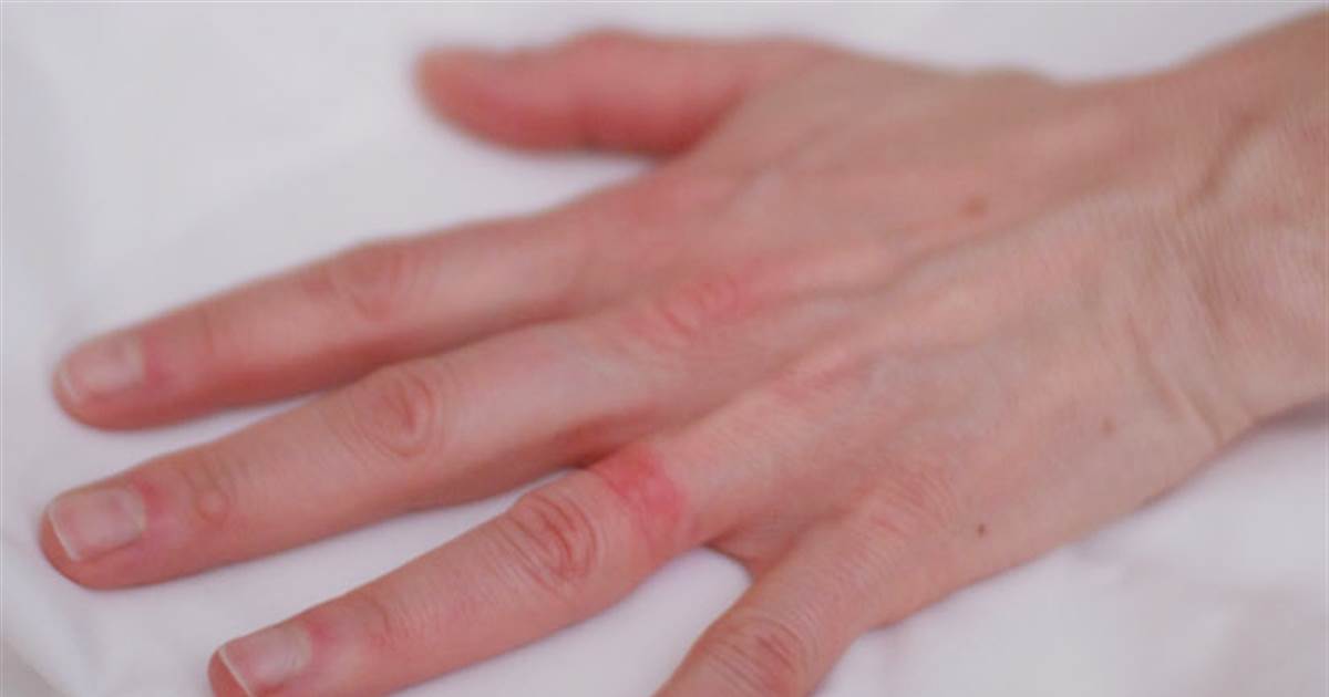 ring marks on finger